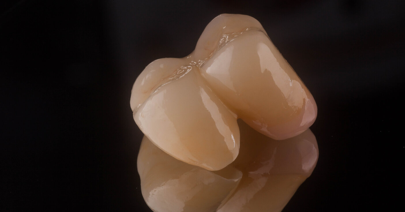 Cantilever Zirconia Bridge