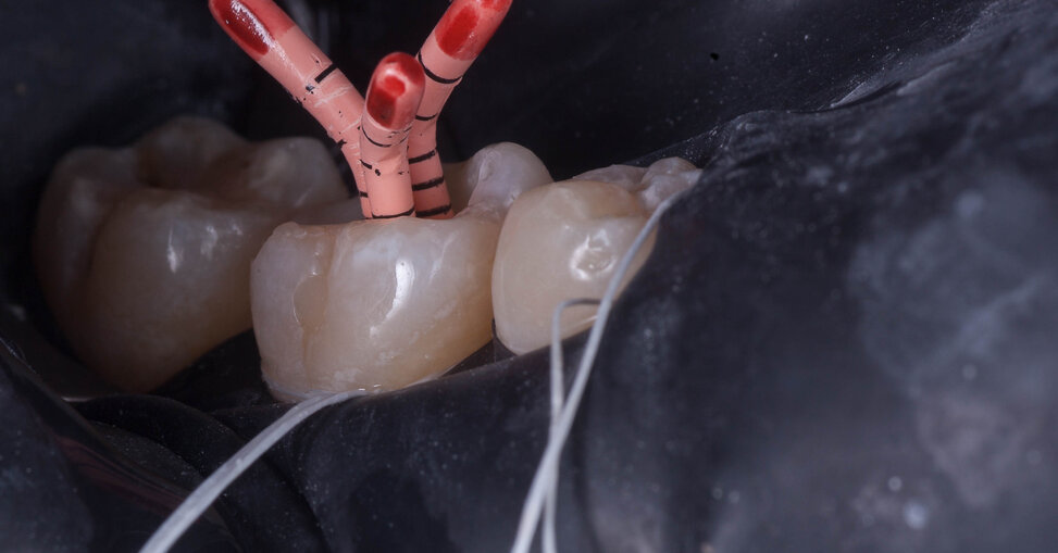 Endodontic Therapy