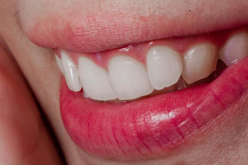 Natural-looking smile with healthy teeth